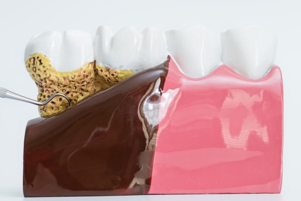 Gum Disease and Tooth Decay