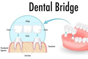Dental Bridges Explained: Cost, Procedure & Long-Term Benefits