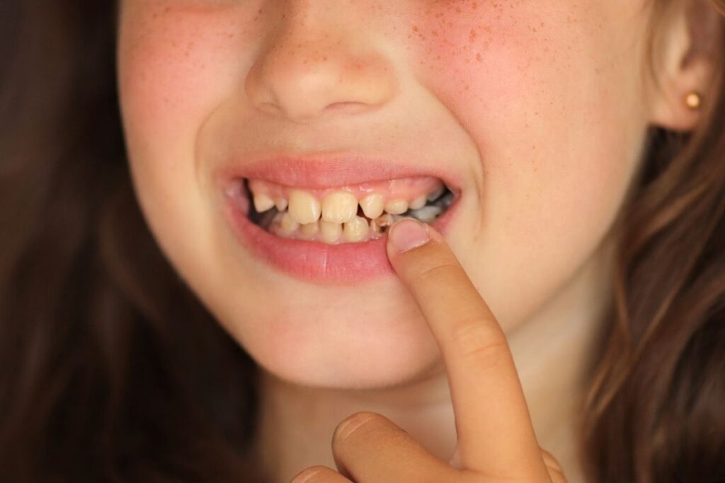 How sugar causes tooth decay