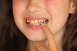 How sugar causes tooth decay