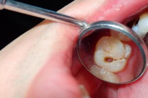 Cavity Treatment Options Modern Dentistry