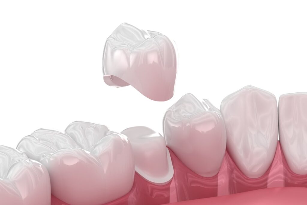 same-day crowns vs traditional crowns