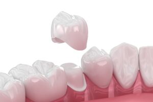 same-day crowns vs traditional crowns