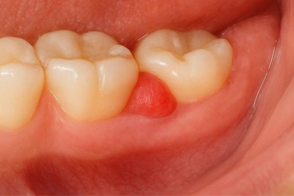 gum flap over a molar