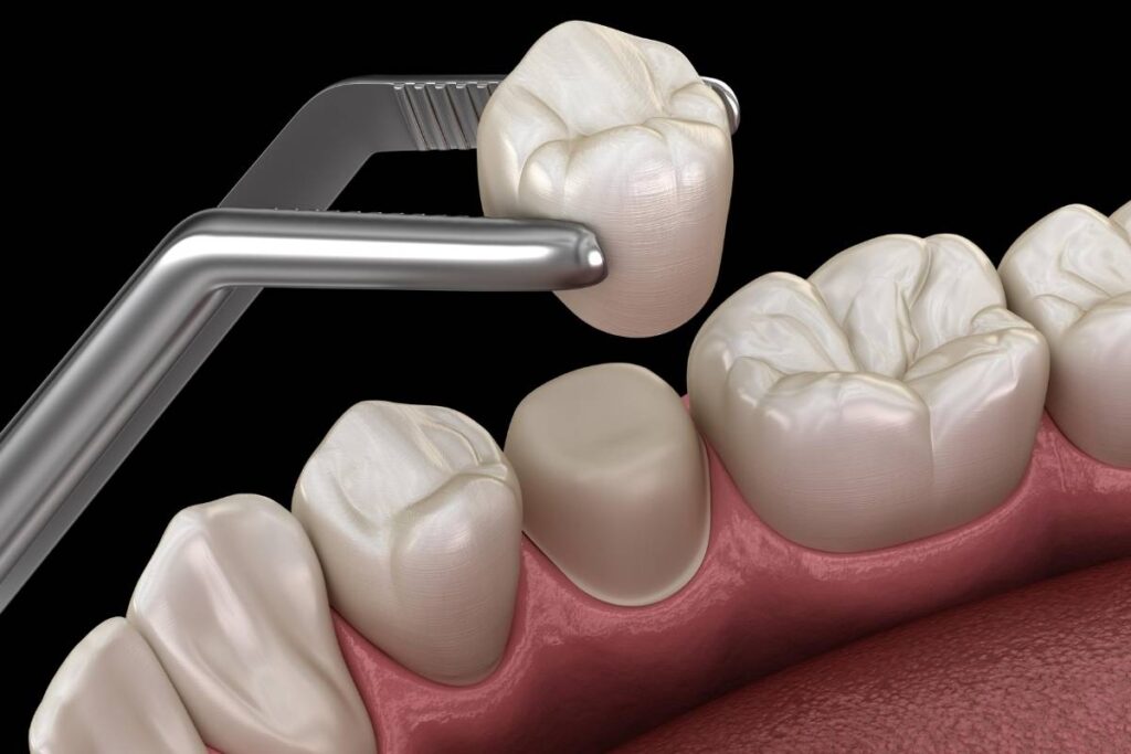 dental crown fallen out
