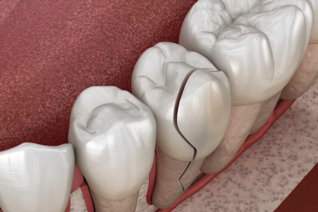 Fix Crooked Teeth