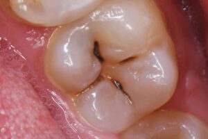 How to Prevent Cavities