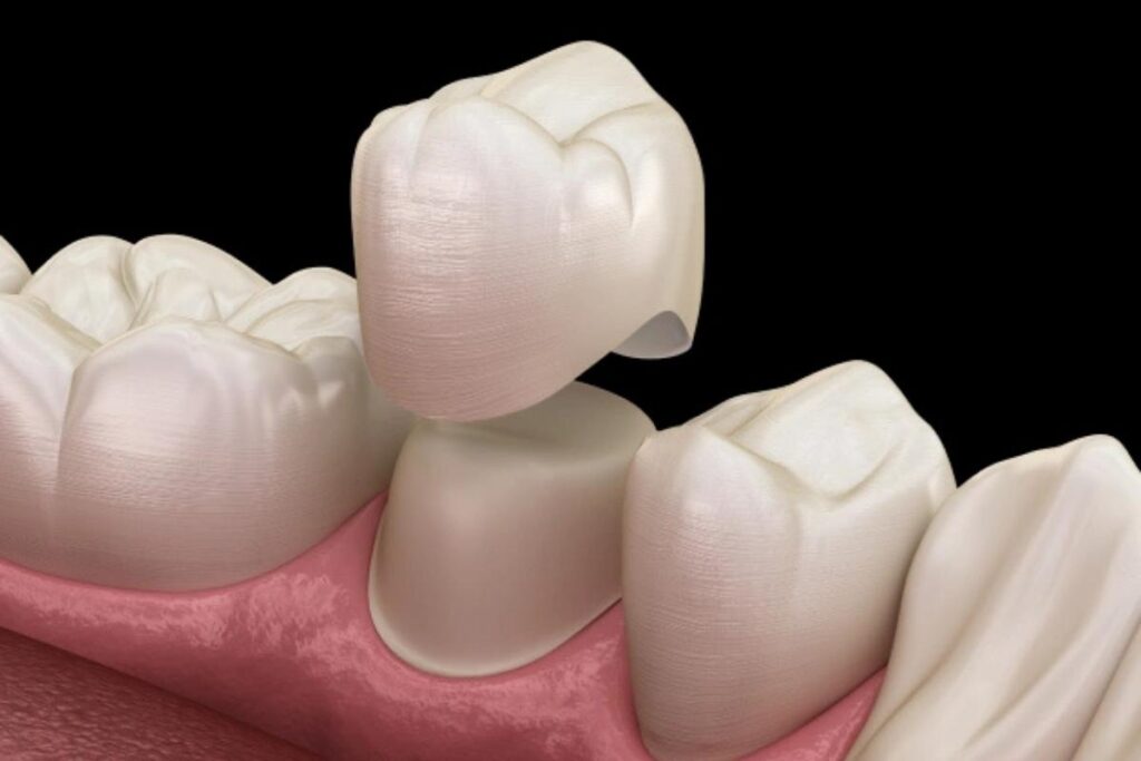Signs you need a dental crown